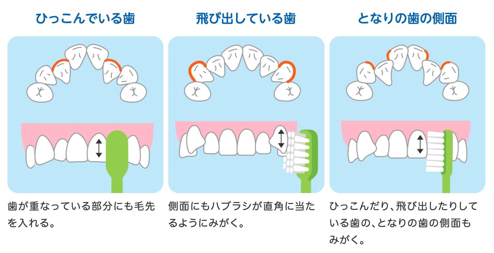 歯並びの悪いところの磨き方